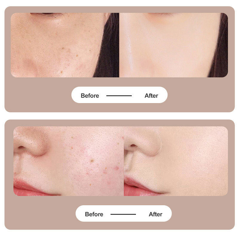 BowLift | Plasma Pen Laser for Tattoo and Mole Removal