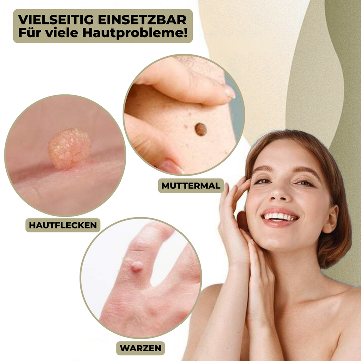 BowLift | DermaLinx Wart Remover | Pain-Free Removal of Warts & Moles | For Home | Without Surgery