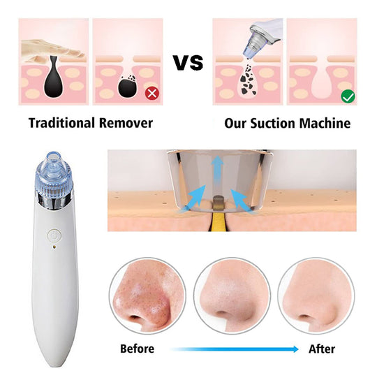 BowLift | LuxeGlow Elite Blackhead Remover | Rechargeable 4-in-1 solution for a clear, radiant skin