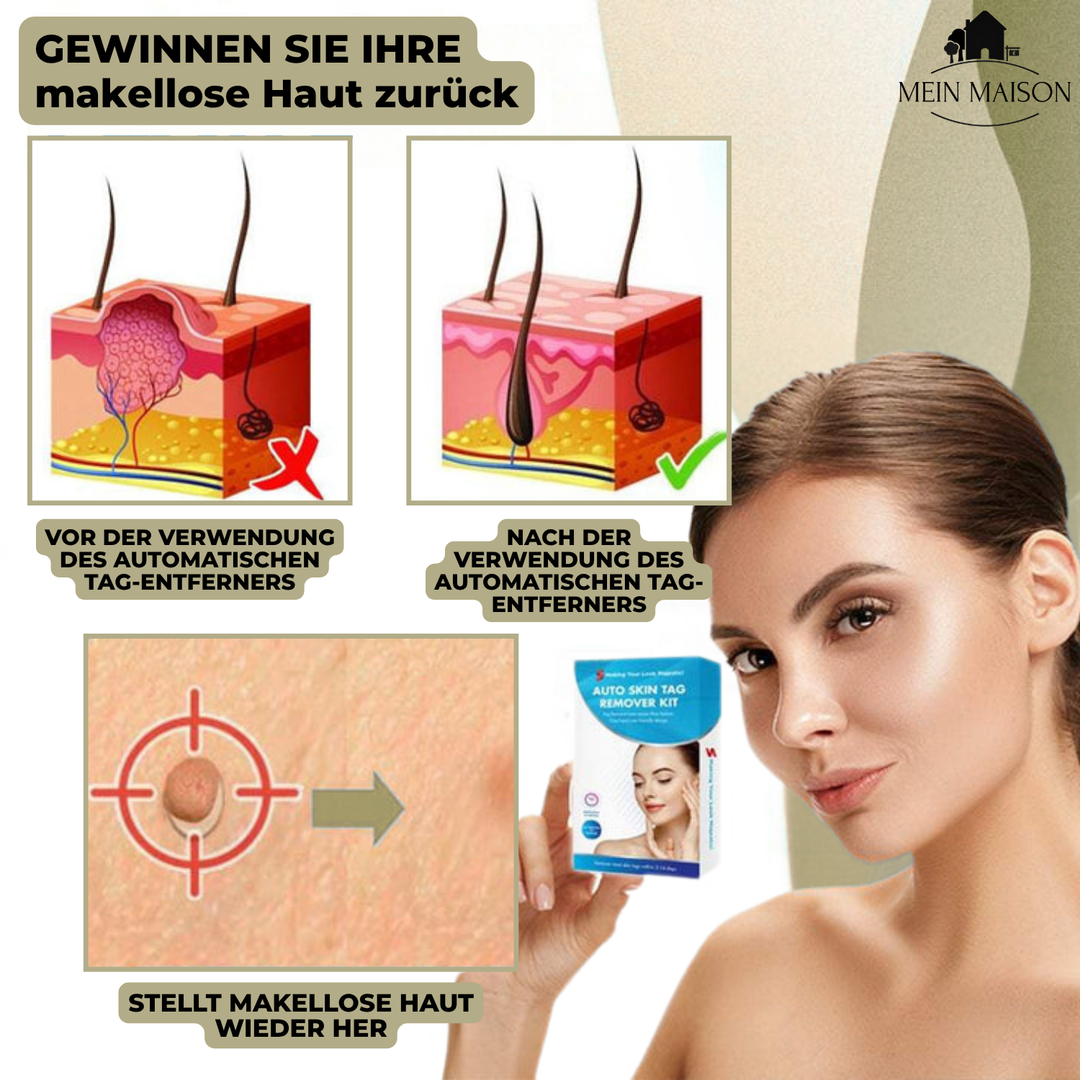 BowLift | DermaLinx Wart Remover | Pain-Free Removal of Warts & Moles | For Home | Without Surgery
