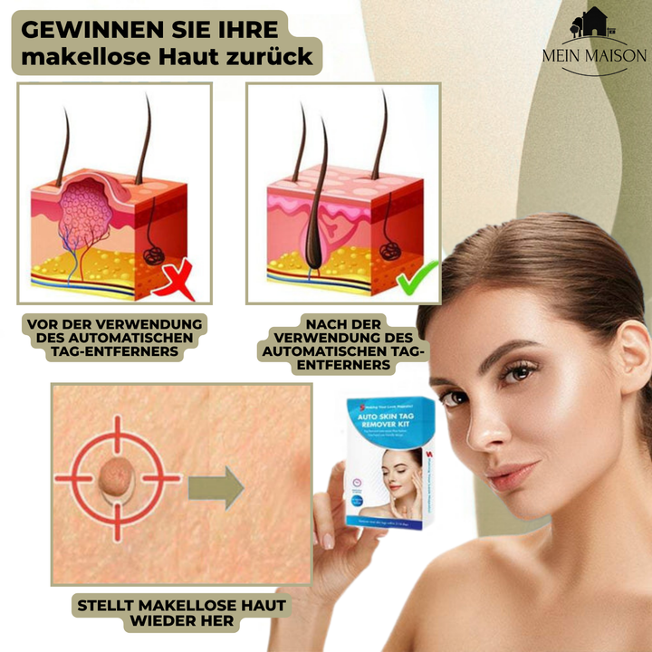 BowLift | DermaLinx Wart Remover | Pain-Free Removal of Warts & Moles | For Home | Without Surgery