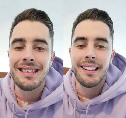 BowLift | On Smile Veneers (Upper and Lower Jaw included)