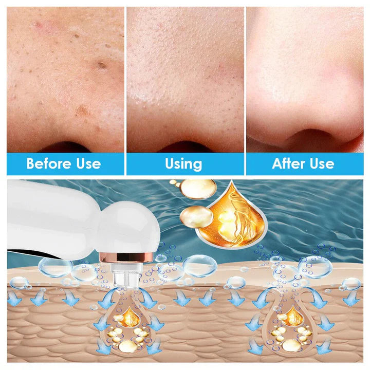 BowLift | Blackhead Remover and Hydrodermabrasion Device