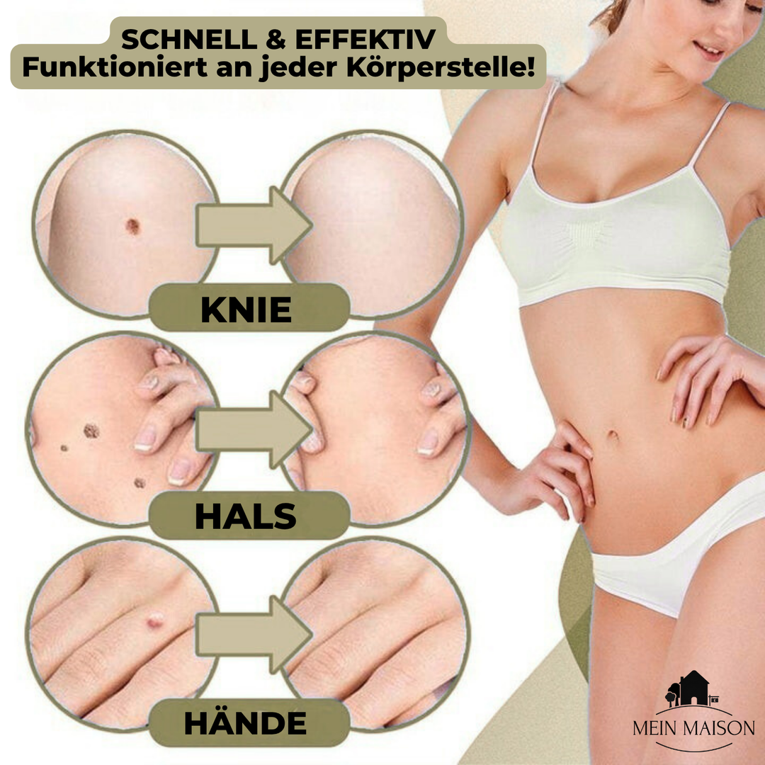 BowLift | DermaLinx Wart Remover | Pain-Free Removal of Warts & Moles | For Home | Without Surgery