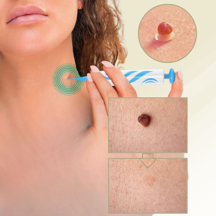 BowLift | DermaLinx Wart Remover | Pain-Free Removal of Warts & Moles | For Home | Without Surgery