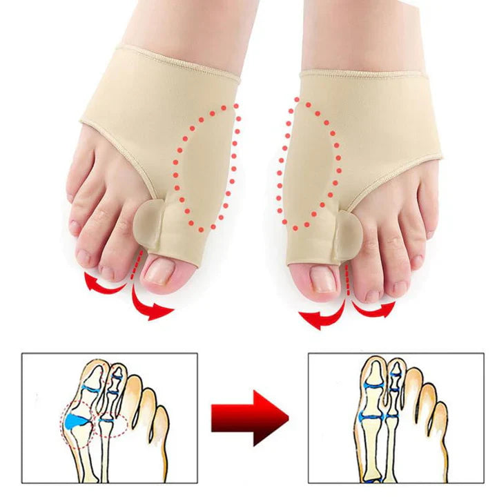 BowLift | Hallux-Valgus-Correction Protection (1 Pair)