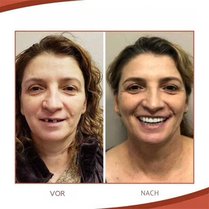 BowLift | Biocompatible  Prosthesis Set for Pain-Free Fit and Natural Smile