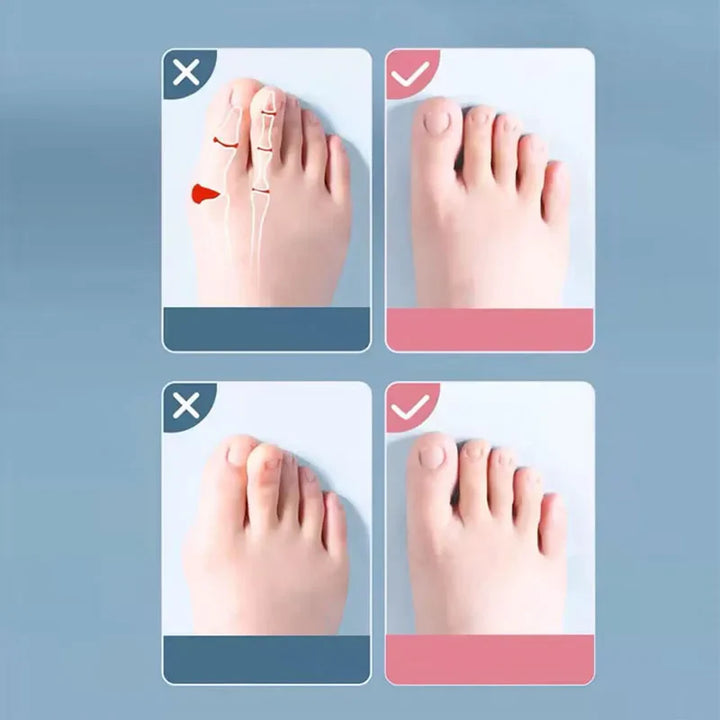 BowLift | Silicone Hallux Valgus Bunion Corrector