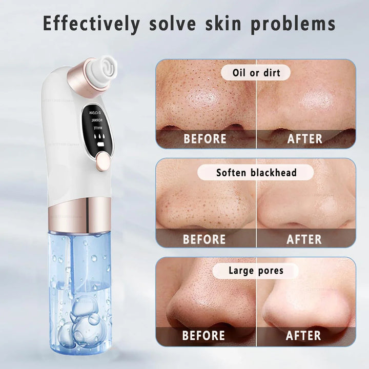 BowLift | Acne Black Head Deep Clean Removal