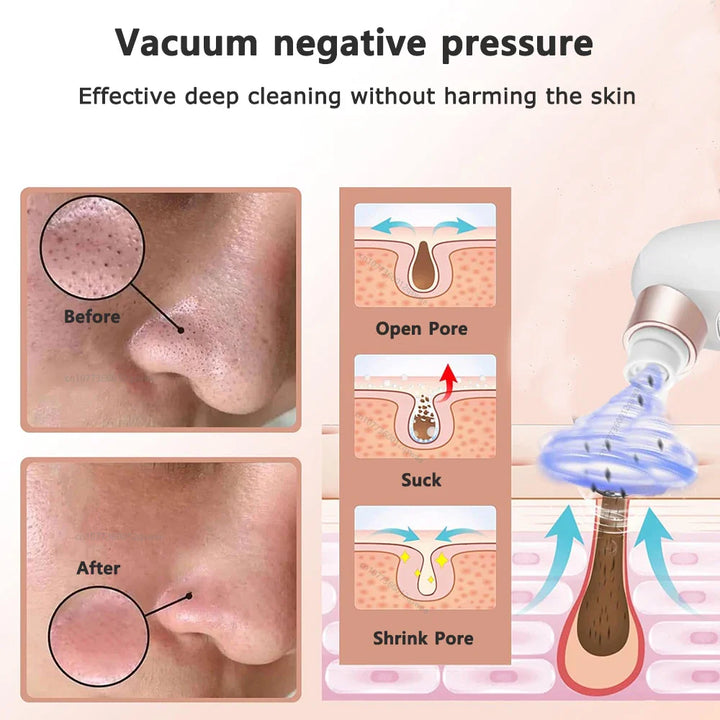 BowLift | Acne Black Head Deep Clean Removal