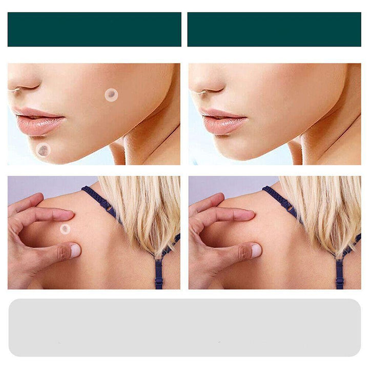 SkinClear - Patch for the removal of spots and warts Bowlift