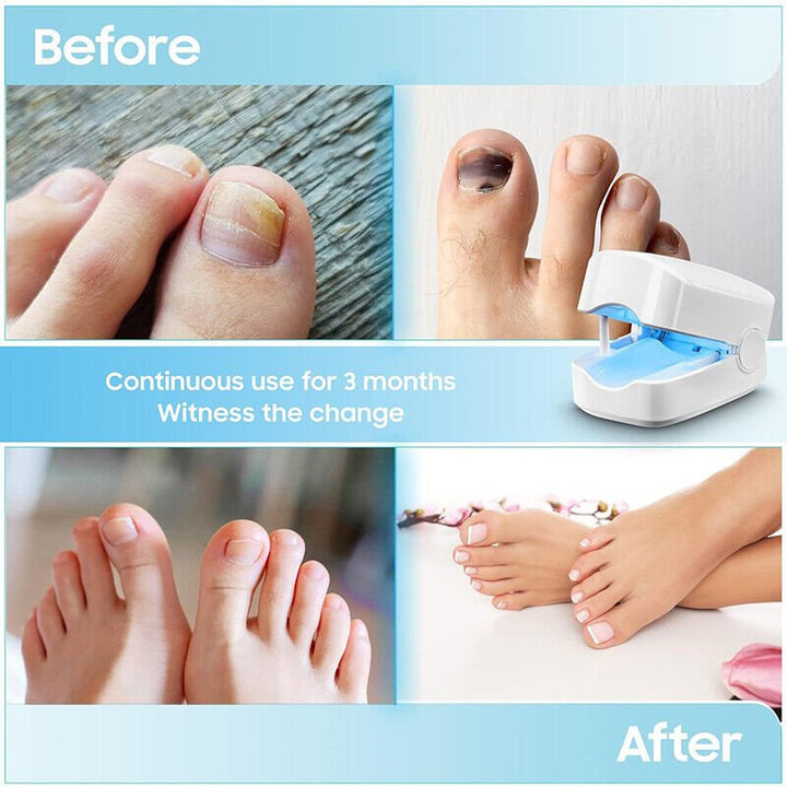 Laser device for nail fungus cleaning – Revolutionary, highly efficient light therapy device from Expert for toenail diseases Bowlift